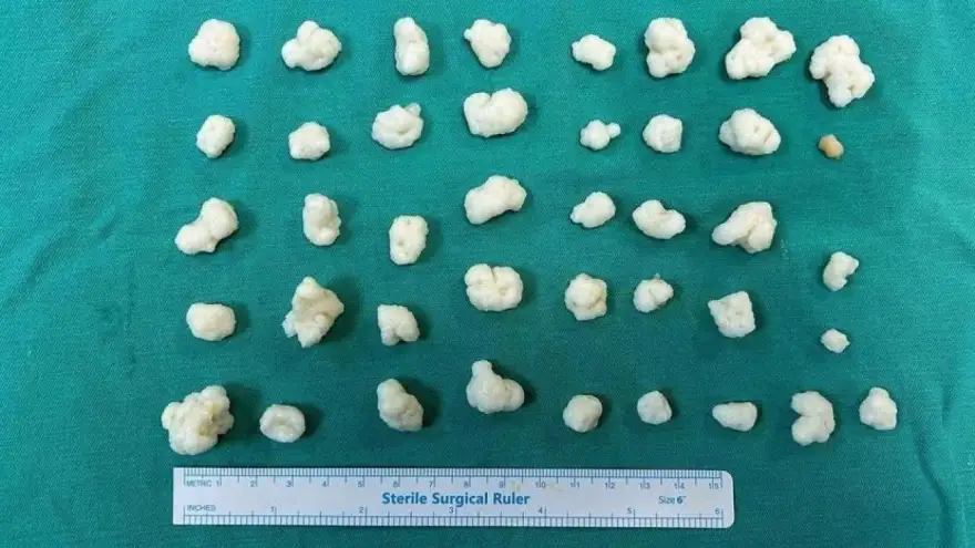 Hastanın dizinden 41 "eklem faresi" çıkarıldı