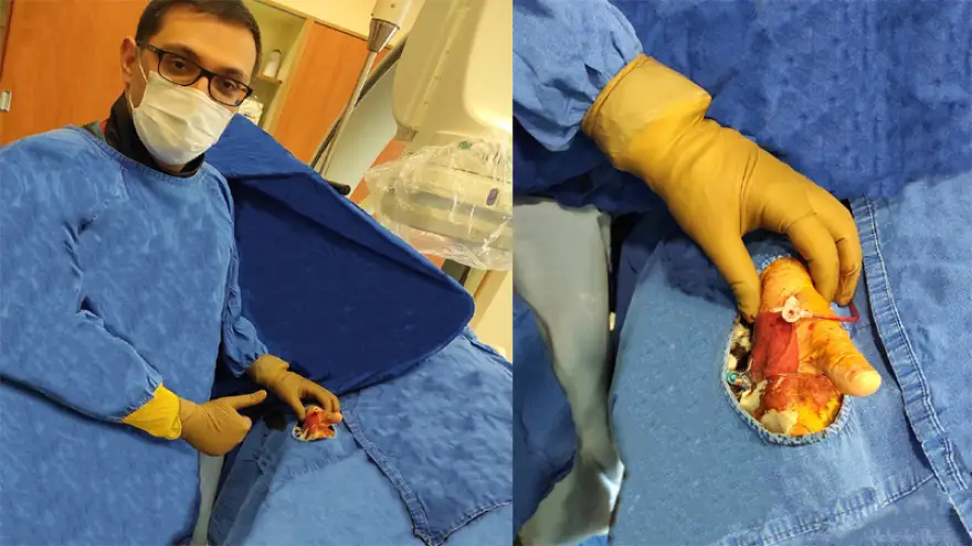 Sanko Üniversitesi Hastanesi’nde başparmaktan anjiyo işlemi 